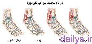 darmanpichkhordeghi mochpa irnab ir درمان پیچ خوردگی مچ پا