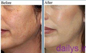 leyzerfractional chist irnab ir لیزر فرکشنال چیست؟